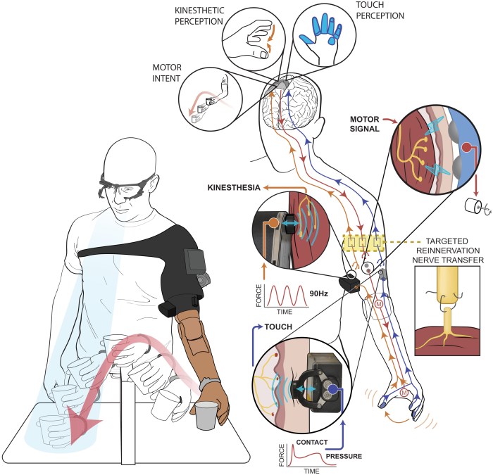 Local man receives first neuro-prosthetic knee: ‘A major milestone’