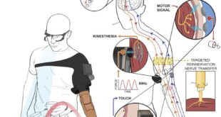 Local man receives first neuro-prosthetic knee: ‘A major milestone’