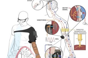 Local man receives first neuro-prosthetic knee: ‘A major milestone’